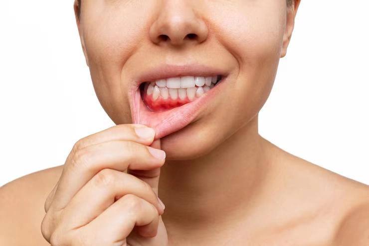 Gengiva sangrando: sinais, causas e como a periodontia atua